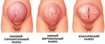 На каком сроке беременности можно делать кесарево сечение