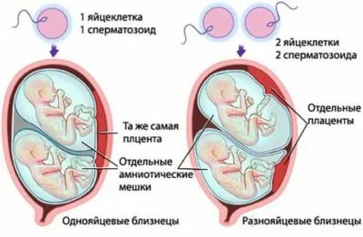Как возникает многоплодная беременность