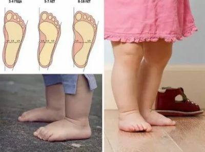 Что такое плоскостопие у детей