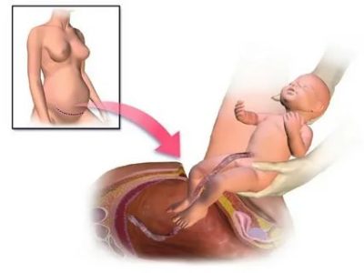 На каком сроке беременности можно делать кесарево сечение