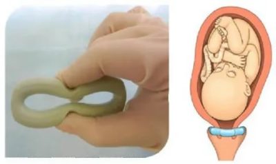 Для чего ставят кольцо во время беременности
