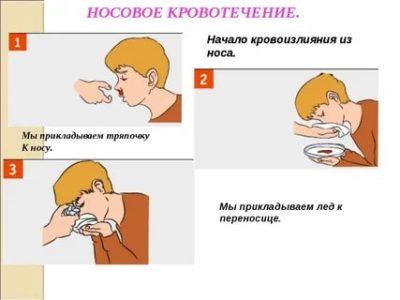 Как быстро остановить кровь из носа у ребенка