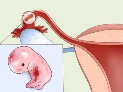 Что такое внематочная беременность
