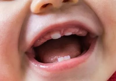 Какие симптомы при прорезывании зубов